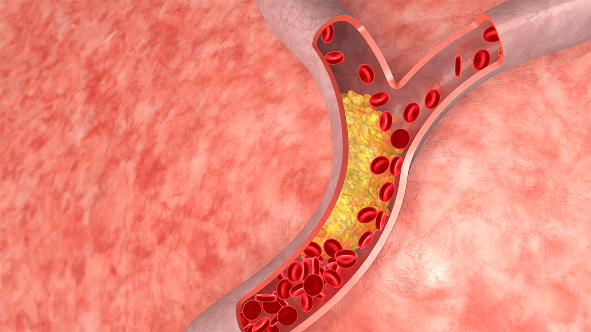 Cholesterol cao gây ra những vấn đề gì?